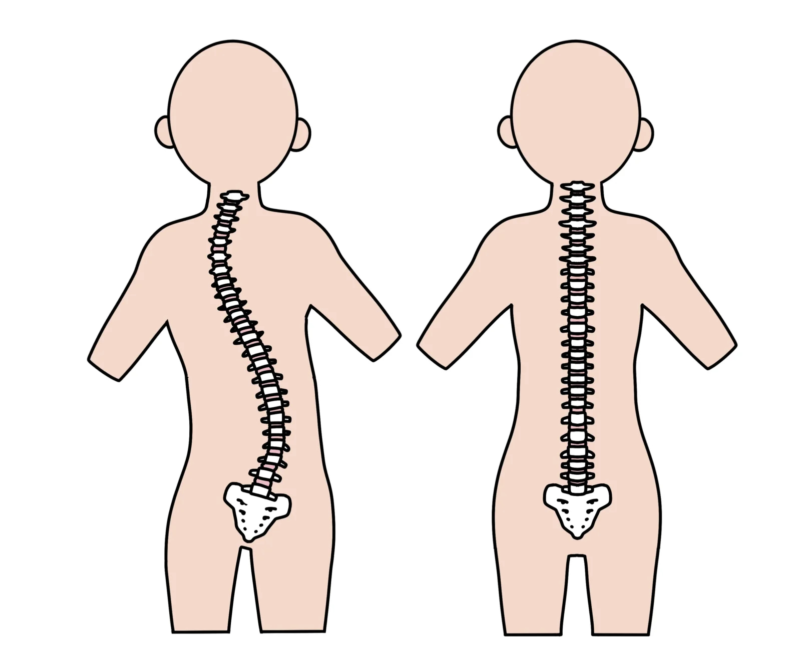 脊柱側弯症を示す脊椎のイラスト