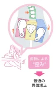 歪んだ骨盤を示すイラスト