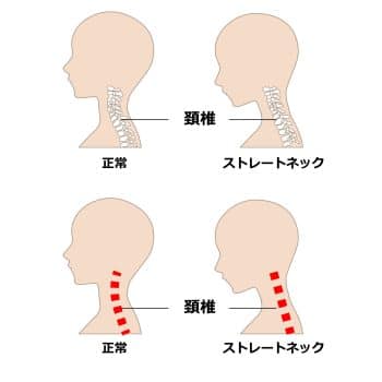 ストレートネックを示す首の骨格のイラスト